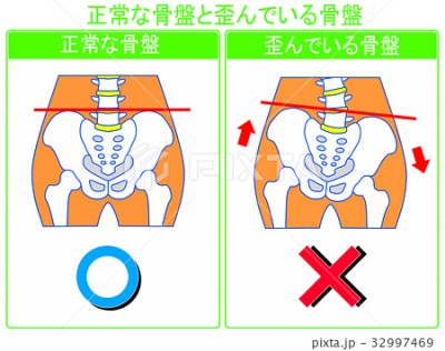 骨盤ゆがみ2