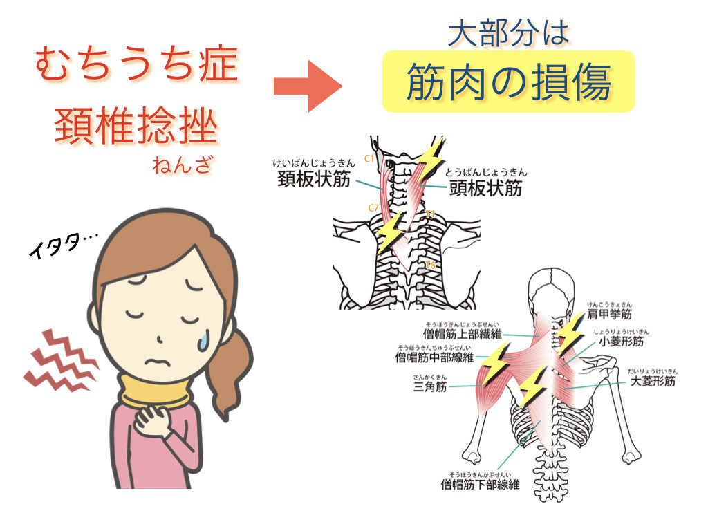 朝起きたら首がつらい方 はりきゅう院だん の治療で劇的に痛み改善 はりきゅう院だん