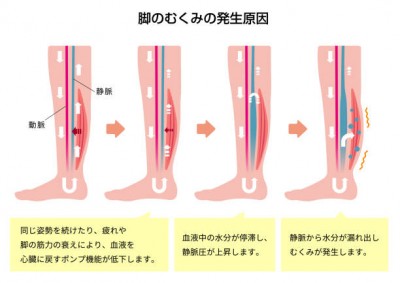 むくみ原因